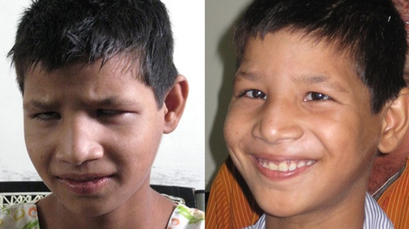 Before and after image of a 10-year-old boy